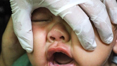 Kementerian Kesehatan Temukan Kasus Lumpuh Layu Akut Akibat Virus Polio di Jateng dan Jatim