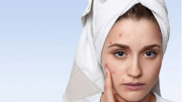 Acne Patch, Bikin Jerawat Hilang atau Malah Meradang? Begini Kata Dermatologis