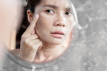 Flek Hitam di Wajah Bisa Hilang Hanya dengan Produk Skincare?