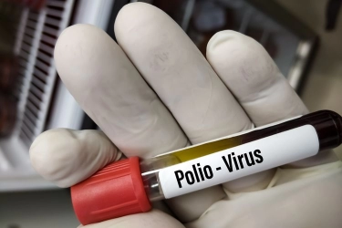 Gejala Awal Polio Mirip Infeksi Saluran Pernapasan