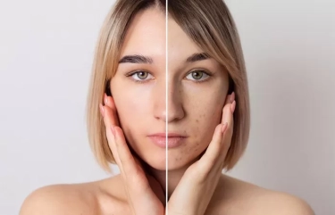 8 Vitamin dan Suplemen Untuk Mengatasi Kulit Kering