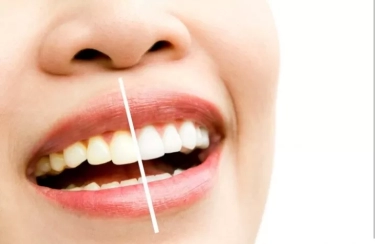 7 Penyebab Gigi Tetap Kuning Meski Rutin Sikat Gigi, Apa Saja? Simak Penjelasan Berikut