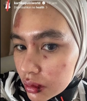 Bagian Wajah hingga Lidah Kartika Putri Melepuh, Kini Berobat di Singapura