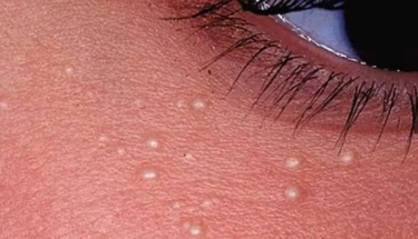 Milia di Wajah Dapat Mengganggu Penampilan? Ketahui 5 Cara Menghilangkannya dengan Aman Menurut Ahli Dermatologi