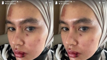 Kartika Putri Alami Penyakit Misterius, Anggap Penderitaannya Tak Seberapa Dibanding Orang Palestina