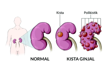 Penyebab Gejala Penyakit Ginjal Polikistik, Simak Penjelasan Pencegahannya