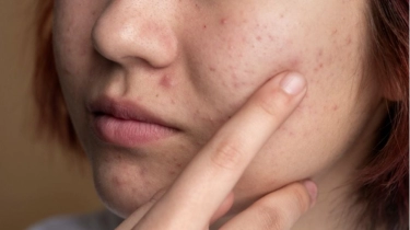 Obati Jerawat dan Cegah Penuaan Dini Tak Cukup Cuma Pakai Skincare di Wajah, Dokter Kulit Sarankan Ini