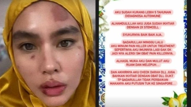 Kartika Putri Idap Sindrom Stevens-Johnson yang Akibatkan Kebakar pada Kulit Wajah