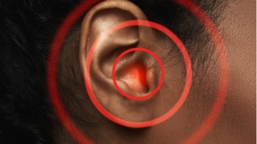 Kemenkes Ungkap Angka Gangguan Pendengaran Terus Meningkat, Bisakah Dicegah?