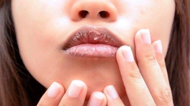 Rentan Alami Bibir Kering dan Sariawan Saat Puasa, Ini Penjelasan Dokter