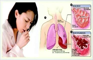 KOPI TB Pusat Sebut Tuberkulosis Bisa Diobati dan Dicegah Lewat Terapi Pencegahan Tuberkulosis