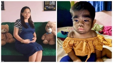 Anaknya Derita Sindrom Werewolf, Ibu di Filipina Menyesal Sering Makan Kucing saat Hamil