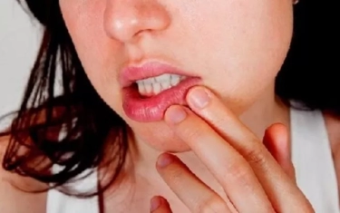 5 Cara Cegah Sariawan yang Ampuh, Salah Satunya dengan Hindari Menggigit Bibir