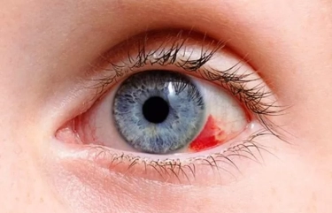 6 Bercak Merah Pada Mata yang Perlu Diketahui, Simak Penyebab dan Cara Penanganannya