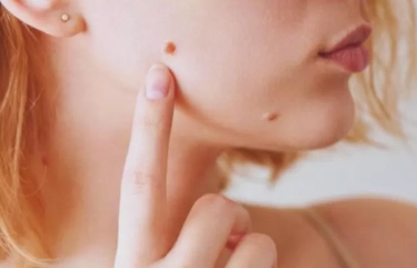 Mengenal Jenis dan Tanda Kutil yang Berbahaya dan Bisa Memicu Komplikasi