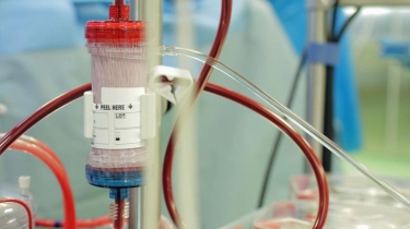Cegah Komplikasi Fatal, Kapan Waktu Tepat Memulai Cuci Darah?