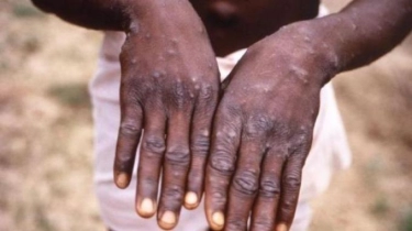 9 Fakta Virus Monkeypox Jenis Baru, Menyebar ke Negara Mana, Gejala hingga Cara Melindungi Diri