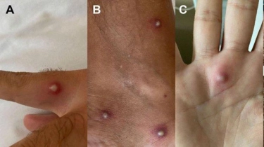 India Konfirmasi Kasus Mpox Pertama, Terdeteksi pada Pria Usia 38 Tahun