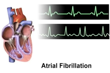 Dear Anak Muda, Jantung Sering Berdegup Kencang Padahal Lagi Nggak Dekat Gebetan? Waspada Gangguan Atrial Fibrillation!