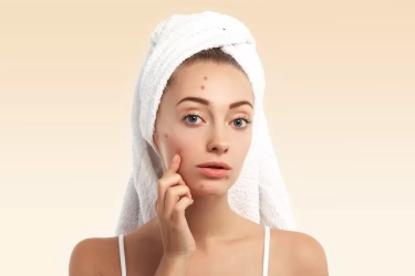 Mengenal Acne Patch yang Dinilai Efektif Menghilangkan Jerawat, Simak Fungsinya di Kulit Wajah Anda