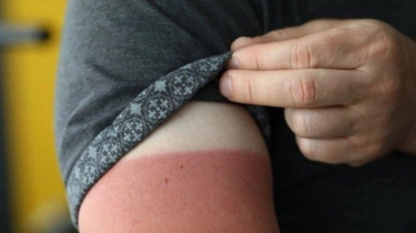 Psoriasis Penyakit Autoimun yang Serang Kulit, Biasanya Dipicu Stres