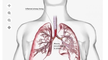 Pneumonia Bisa Tingkatkan Risiko Terjadinya Serangan Jantung, Berikut Penjelasan Dokter