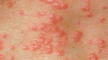 WHO: Lebih 1 dari 5 Orang Dewasa di Dunia Menderita Infeksi Herpes Genital
