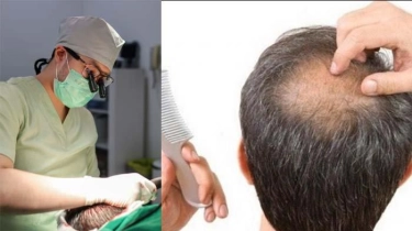 Kepala Botak, Bisakah Langsung Transplantasi Rambut? Ini Saran Dokter 