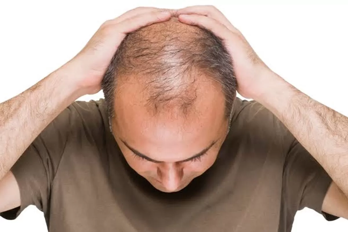 Dokter Jelaskan Penyebab Rambut Rontok yang Masih Tahap Wajar, Laki-laki juga Perlu Waspada