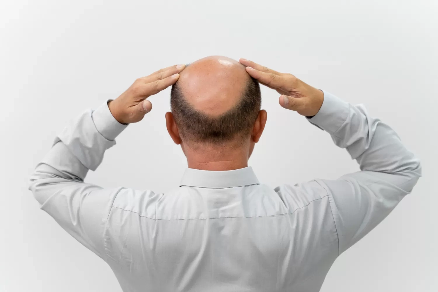 Google Ventures Dukung Penemuan Obat Botak Baru, Diklaim Tumbuhkan Rambut Tebal dalam 7 Hari