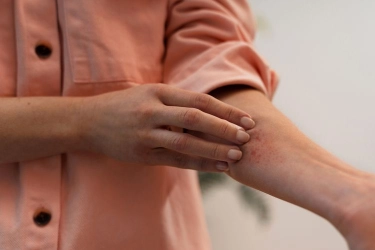 Waspadai Stevens-Johnson Syndrome, Penyakit Langka yang Bisa Mengancam Nyawa