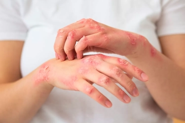 Mengapa Eksim Selalu Terasa Gatal dan Cara Efektif Meredakannya Tanpa Memperparah Kondisi Kulit