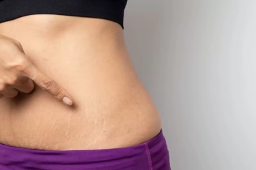 5 Pengobatan Alami Memudarkan Stretch Mark dengan Cepat