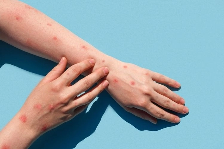 Penyebaran Mpox Meningkat: Kenali Gejalanya dan Lakukan Pencegahan Berikut...