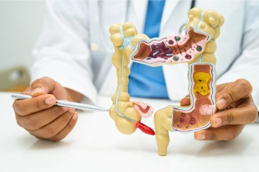 Studi: Kasus Kanker Usus Buntu Meningkat di Kalangan Milenial dan Gen X