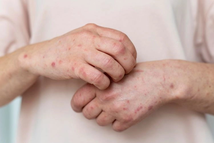 Wabah Mpox Melonjak di Sierra Leone: Status Darurat Kesehatan Global Ditetapkan