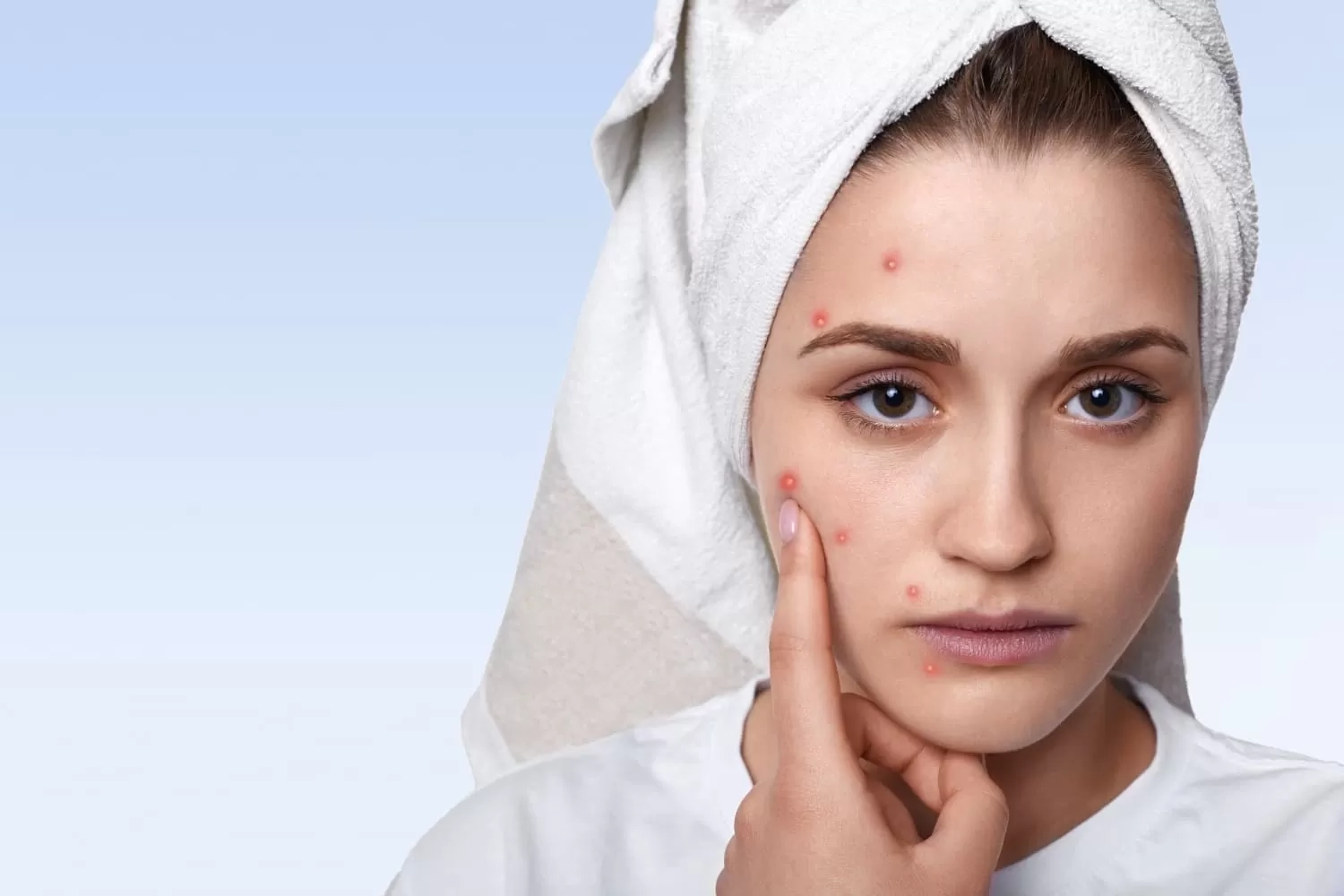 8 Obat Rumahan Paling Ampuh untuk Mengatasi Jerawat, Apa Saja?