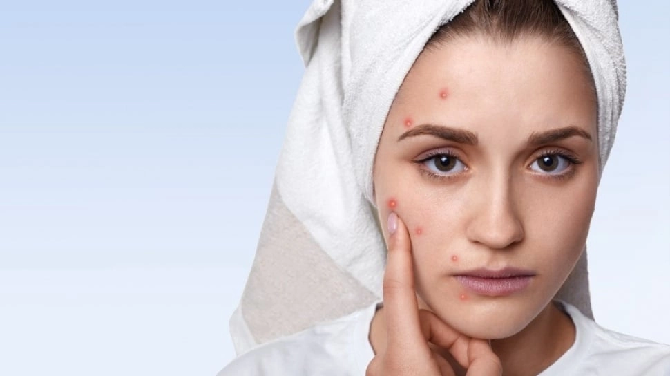 Intip Skincare untuk Kulit Berjerawat Pilihan Ahli