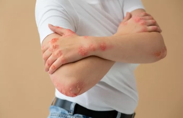 Sering Gatal Saat Cuaca Dingin? Coba 6 Tips Ini untuk Meredakan Alergi Dingin