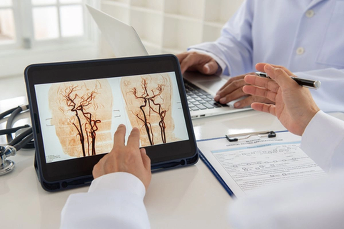 Cegah Stroke dengan Cek Aliran Darah ke Otak