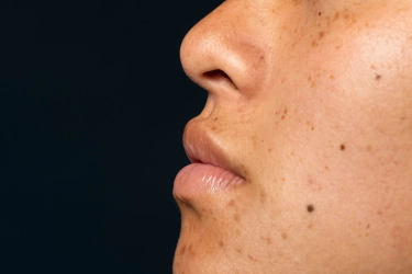 Cara Mengatasi Flek Hitam di Wajah Menurut Dokter, Ini 4 Langkah Skincare Wajib