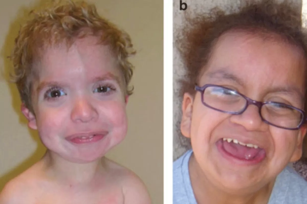 Mengenal Costello Syndrome: Gangguan Genetik Langka yang Pengaruhi Pertumbuhan Fisik dan Mental