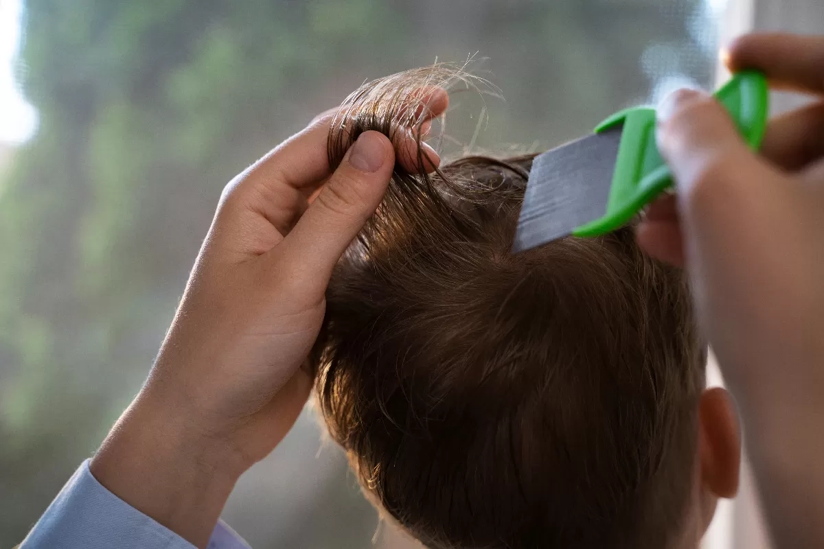 Sulit Hilangkan Kutu Rambut? Ini Trik agar Kepala Bersih dan Nyaman Kembali