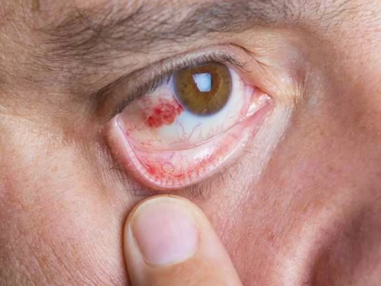 Fakta di Balik Mata Berdarah yang Sering Dianggap Menular, Begini Penjelasan tentang Penyebabnya