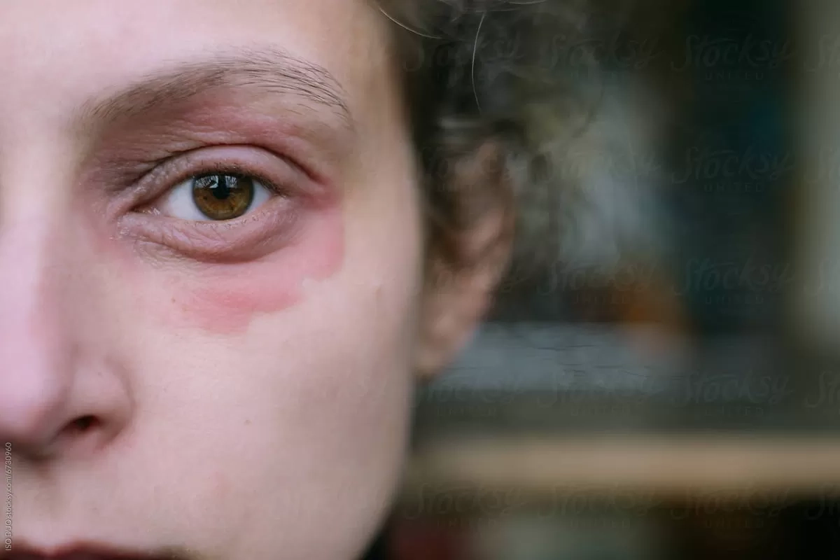 Kulit Gatal Sering Kambuh Tak Menentu? Kenali Istilah Eczema dan 15 Pemicunya yang Belum Disadari Banyak Orang