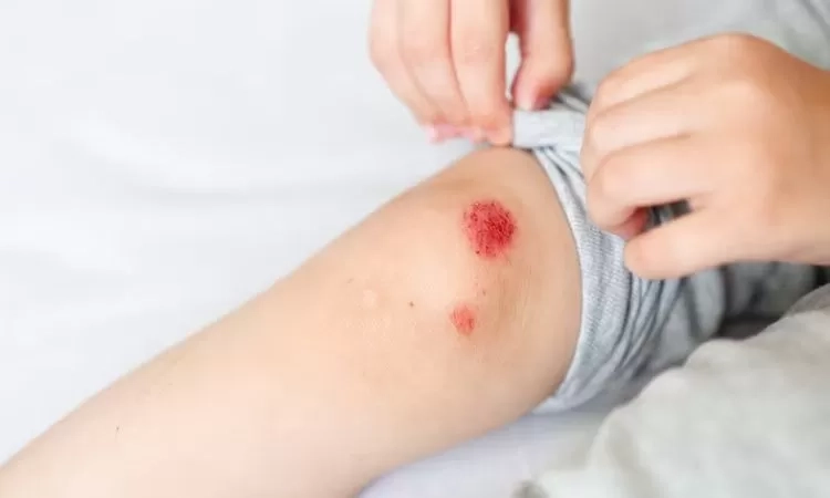 Hidup dengan Hemofilia dan Tantangannya di Indonesia: Penyakit Genetik Langka yang Membuat Pasien Harus Hati-Hati Saat Terluka