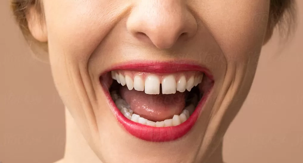 Kekurangan Kalsium dan Dampaknya pada Kesehatan Gigi: Penyebab, Gejala, dan Cara Pencegahannya