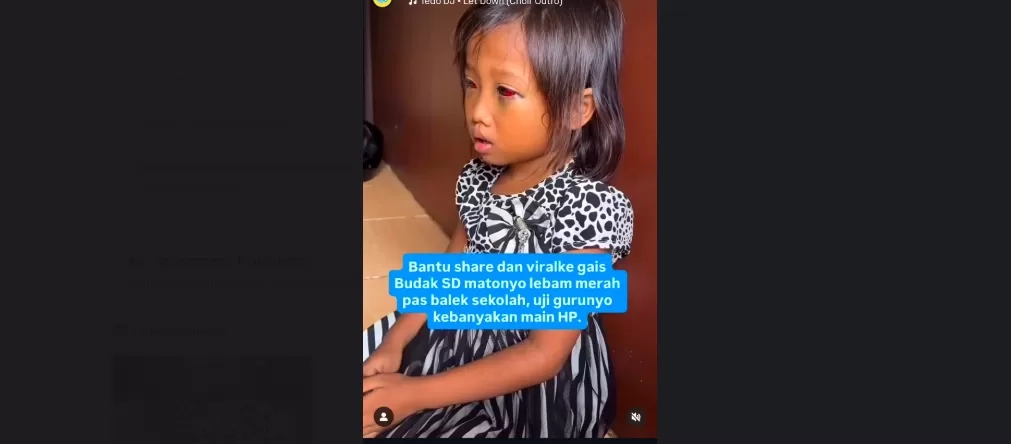 Viral Dugaan Kekerasan Bocah SD di Palembang: Pulang Sekolah Pembuluh Darah di Mata Pecah