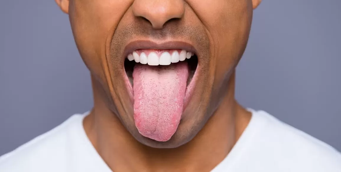 8 Warna pada Lidah Bisa Ungkap Kondisi Kesehatan: Kenali Arti Perubahannya dan Kapan Harus ke Dokter