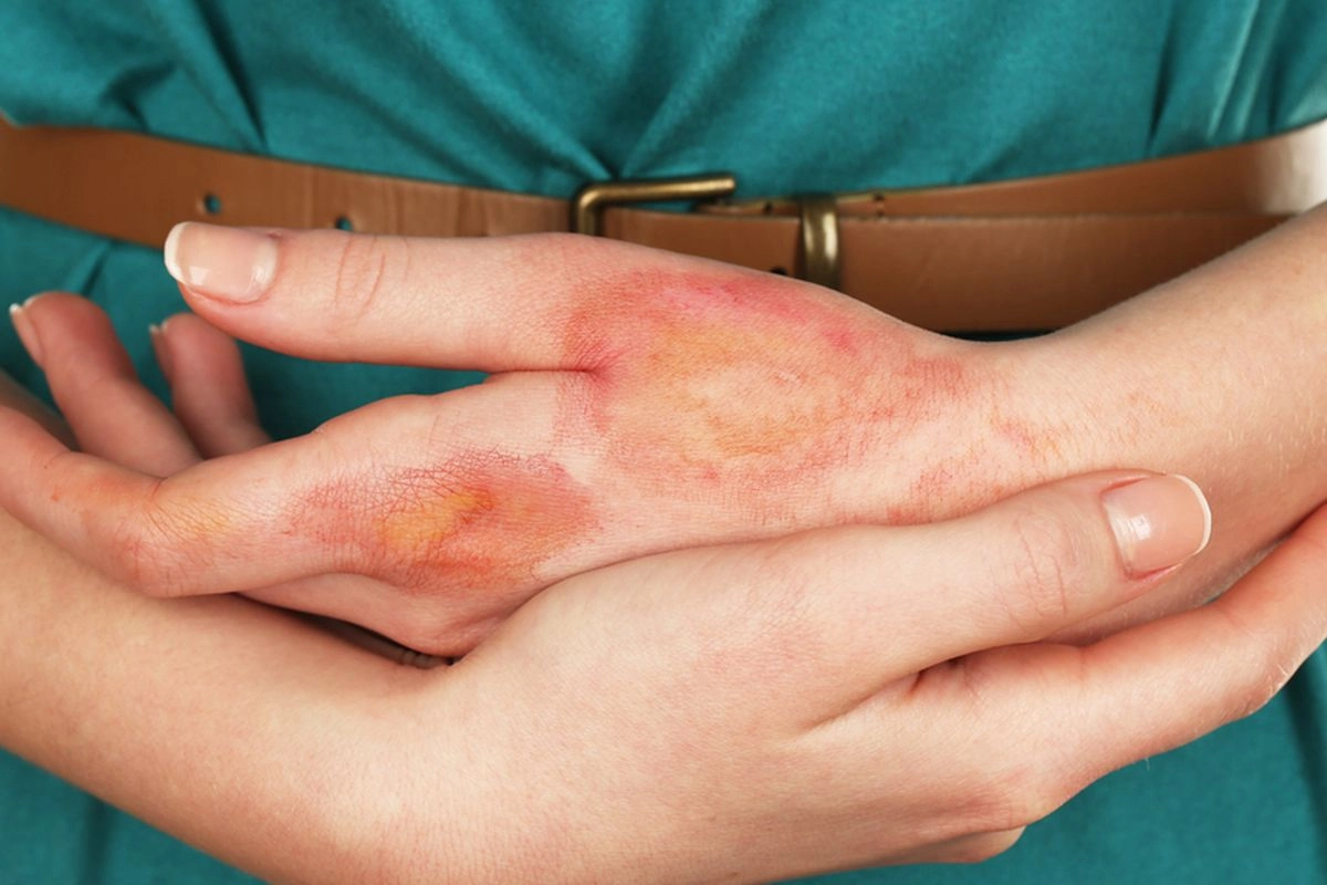 Odol Bisa Mengobati Luka Bakar, Mitos atau Fakta? Ini Kata Dokter